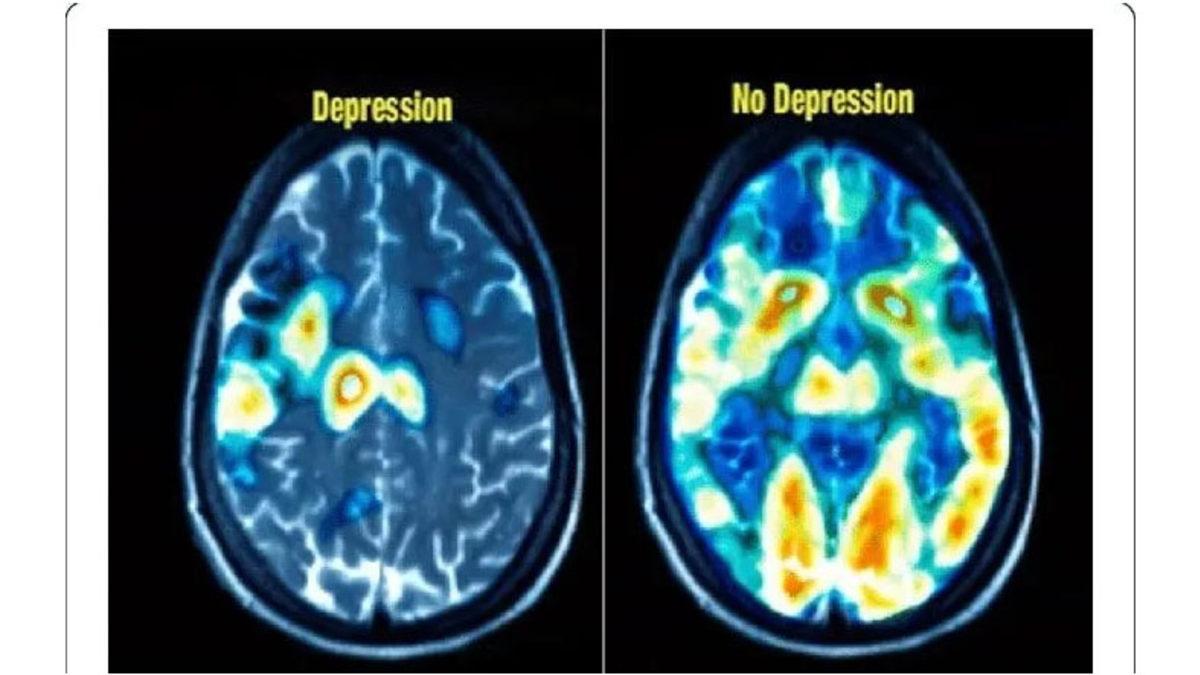 Depresyondaki Kişilerin Beyinlerinde Bulunan Beyin Ağının Ortaya Çıkardığı Şaşırtıcı Sonuç