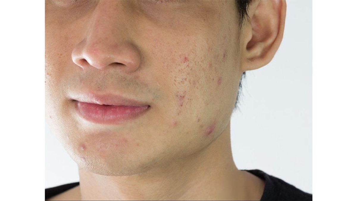 Sivilceyi Sıkmak Gerçekten de İz Bırakıyor mu Yoksa Sadece Bir Efsaneden mi İbaret? (Bırakıyorsa Neden?)