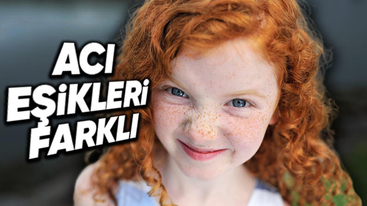 Dünya Nüfusunun Azınlığını Oluşturan Kızıl Saçlı İnsanların Acı Eşiği Bizimkinden Çok Farklı: Peki Sebebi Ne?
