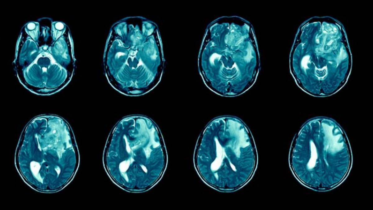 En Ölümcül Beyin Kanseri Türlerinden Birinin Tedavisinde Yeni Umut