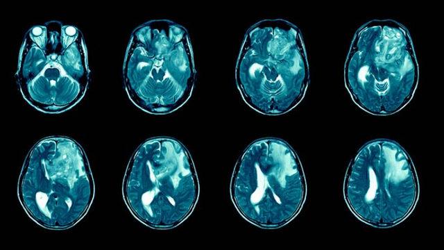 En Ölümcül Beyin Kanseri Türlerinden Birinin Tedavisinde Yeni Umut