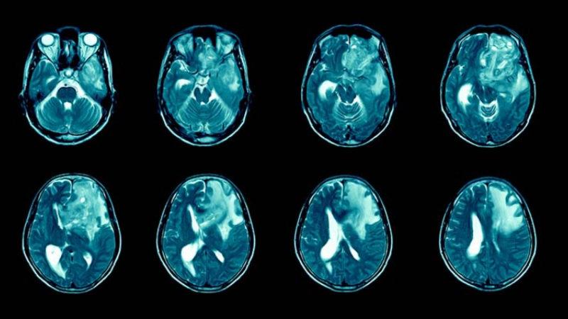 En Ölümcül Beyin Kanseri Türlerinden Birinin Tedavisinde Yeni Umut