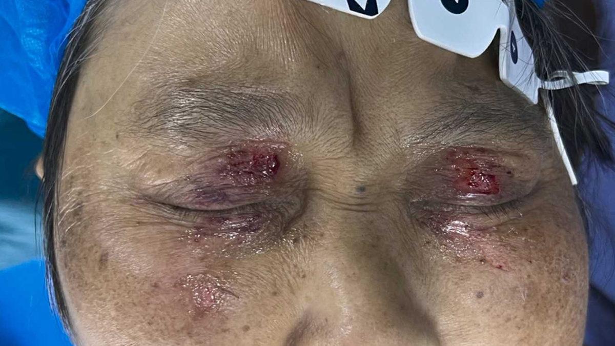 Zaten Uyku Moduna Geçip Gözlerimizi Kapamışız Neden Bazı Ameliyatlarda Üstüne Bir de Gözlerimizi Bantlıyorlar?