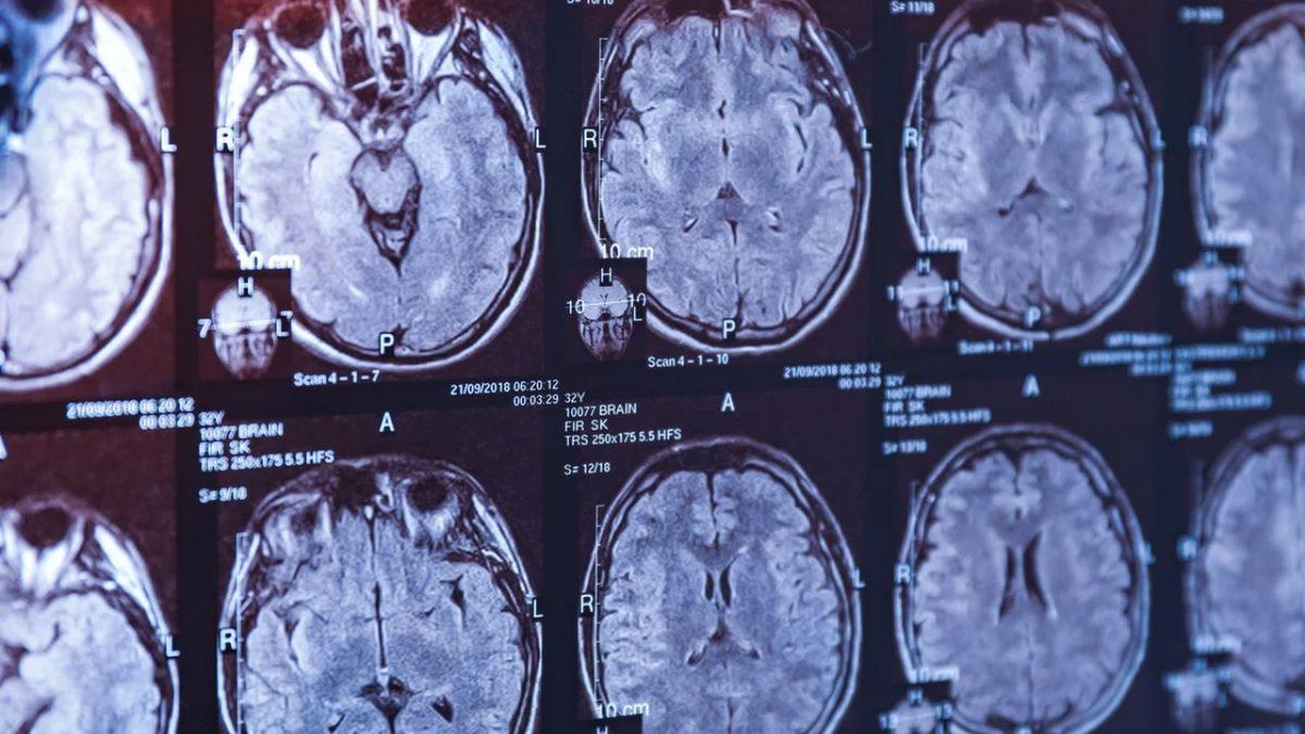 Guinness Dünya Rekorları’na Göre Dünyanın En Ağır Beynine Sahip Olan Adam İle Tanışın: Peki Kaç Kilogram?