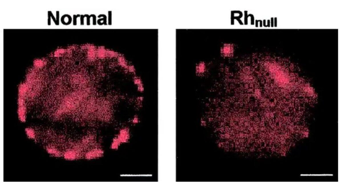 Belki de Hiç Duymadığınız, Çok Az İnsanda Bulunan Kan Grubu İle Tanışın: ‘Altın Kan’ Rh-null Neden Dünyanın En Değerli Kanı?