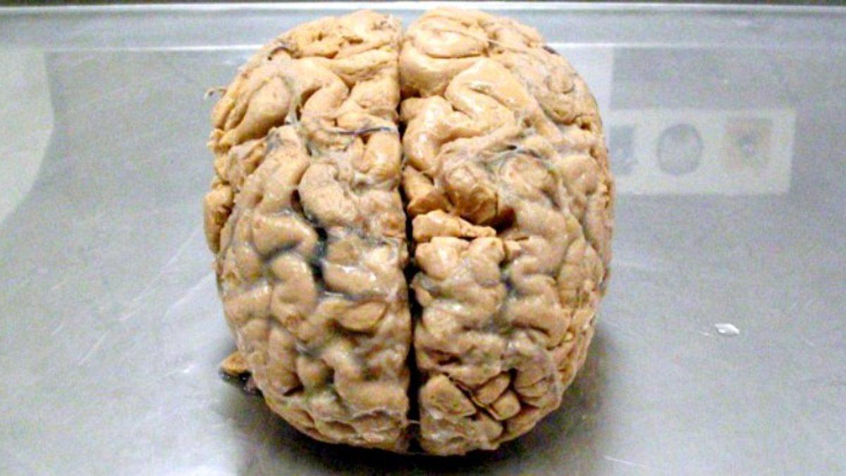 Beyninin %90’ı Hasarlı Olmasına Rağmen Normal Bir Yaşam Süren 44 Yaşındaki O Adamla Tanışın: Peki Bu Nasıl Mümkün Olmuş?