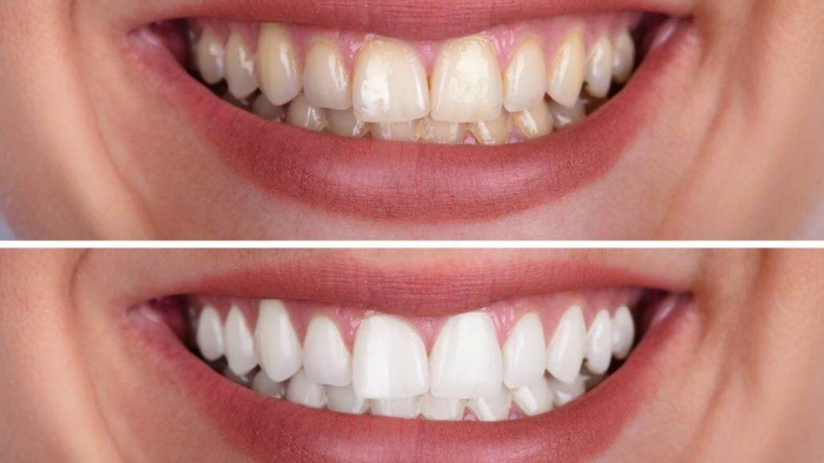 Sararan Dişleri Beyazlatmak İçin Diş Beyazlatıcıları Kullanmak Ne Kadar Doğru?