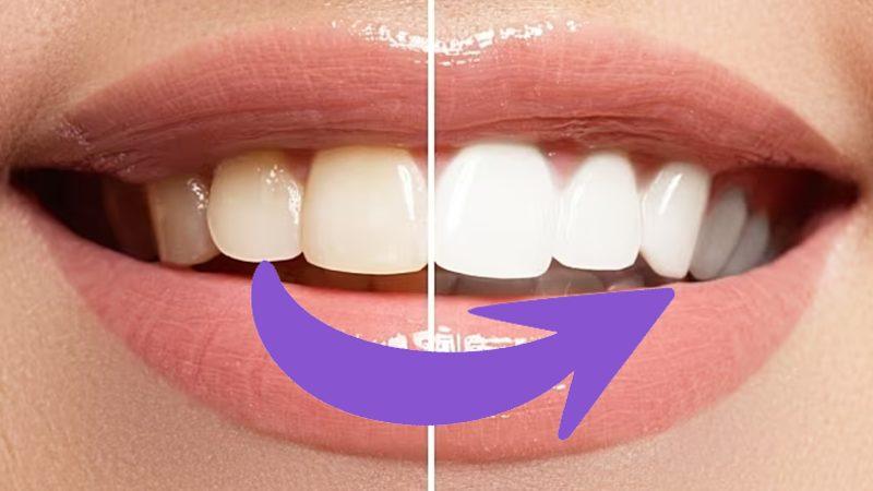 Sararan Dişleri Beyazlatmak İçin Diş Beyazlatıcıları Kullanmak Ne Kadar Doğru?