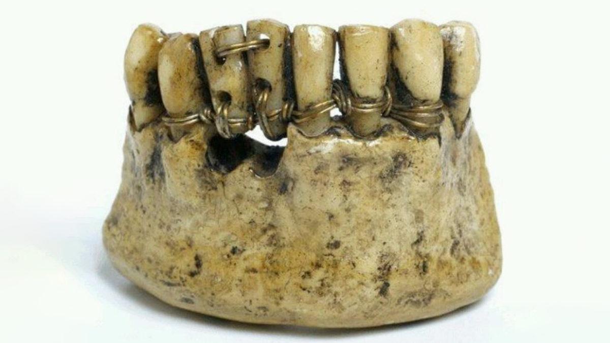 Mide Kaldırır!: Eski Zamanlarda Protez Dişlerin ve Diş Beyazlatmanın Nasıl Yapıldığını Öğrenince Günümüz Teknolojisine Bir Kere Daha Teşekkür Edeceksiniz