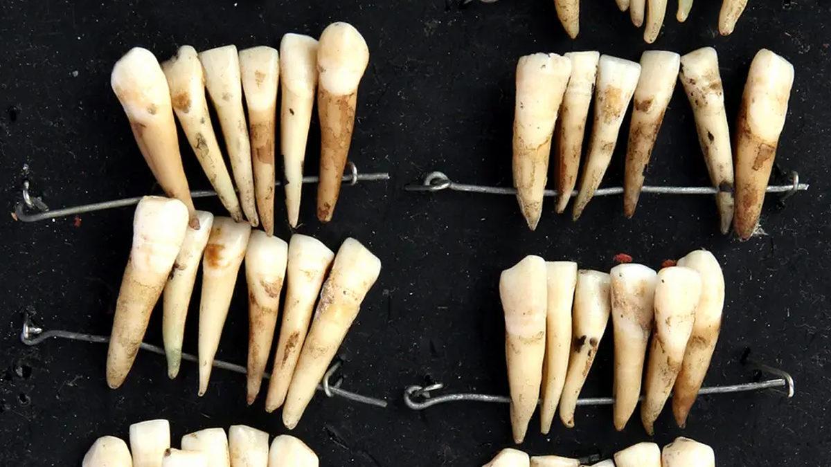 Mide Kaldırır!: Eski Zamanlarda Protez Dişlerin ve Diş Beyazlatmanın Nasıl Yapıldığını Öğrenince Günümüz Teknolojisine Bir Kere Daha Teşekkür Edeceksiniz