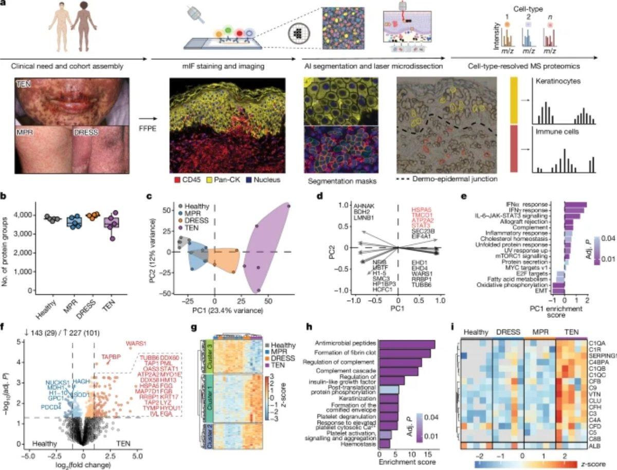 Nadir ve Ölümcül Bir Deri Hastalığı İlk Defa Tedavi Edildi