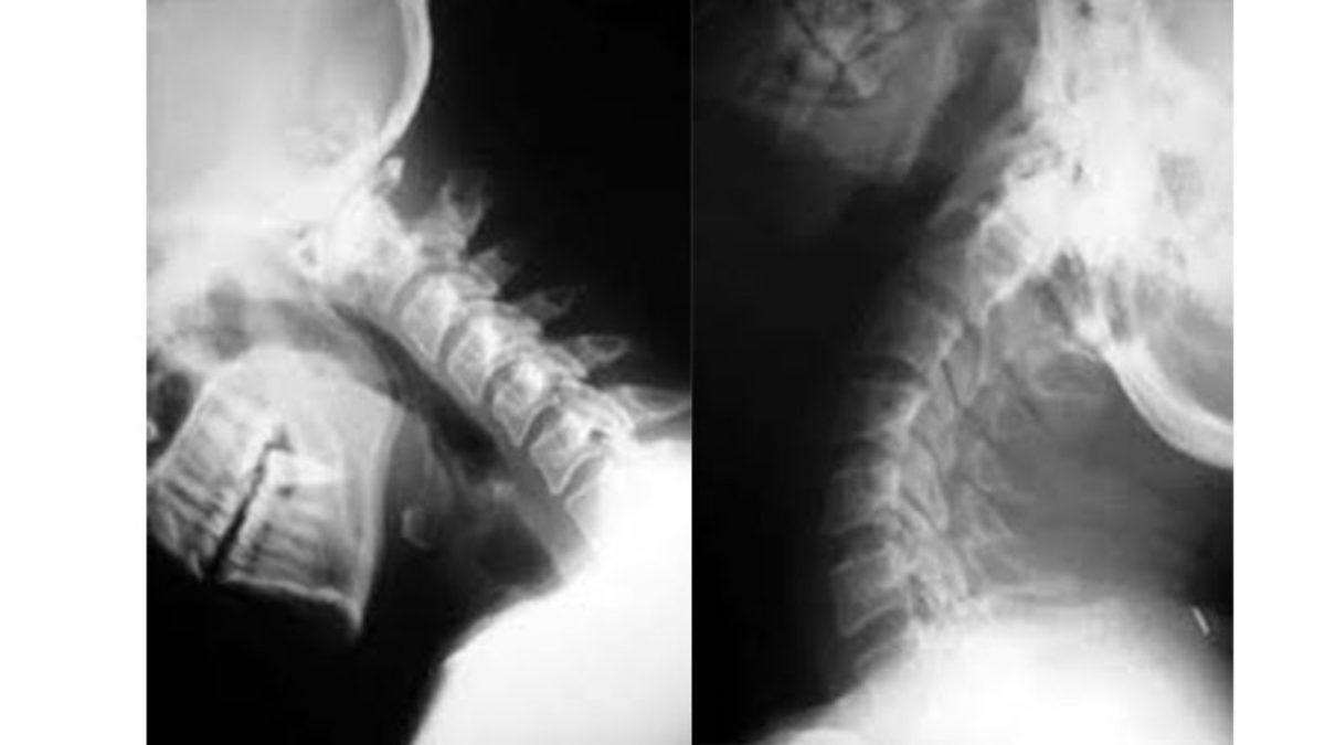 Araba Kazalarında Göz Ardı Edilen Ama Ölüme Kadar Götüren Bir Durum: İç Dekapitasyon Nedir?