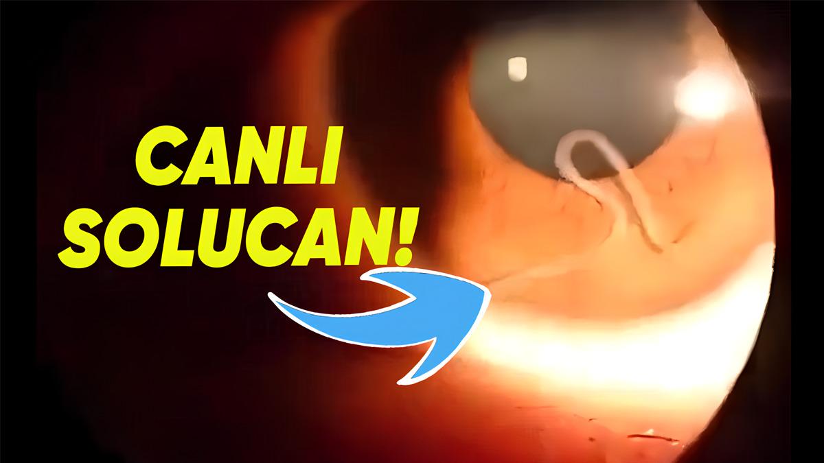 Bir Kadının Sağ Göz Kapağında Büyüyüp Gelişen Bu Canlı Solucanlar Aslında Neyin Nesi?