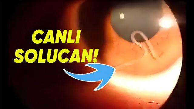 Bir Kadının Sağ Göz Kapağında Büyüyüp Gelişen Bu Canlı Solucanlar Aslında Neyin Nesi?