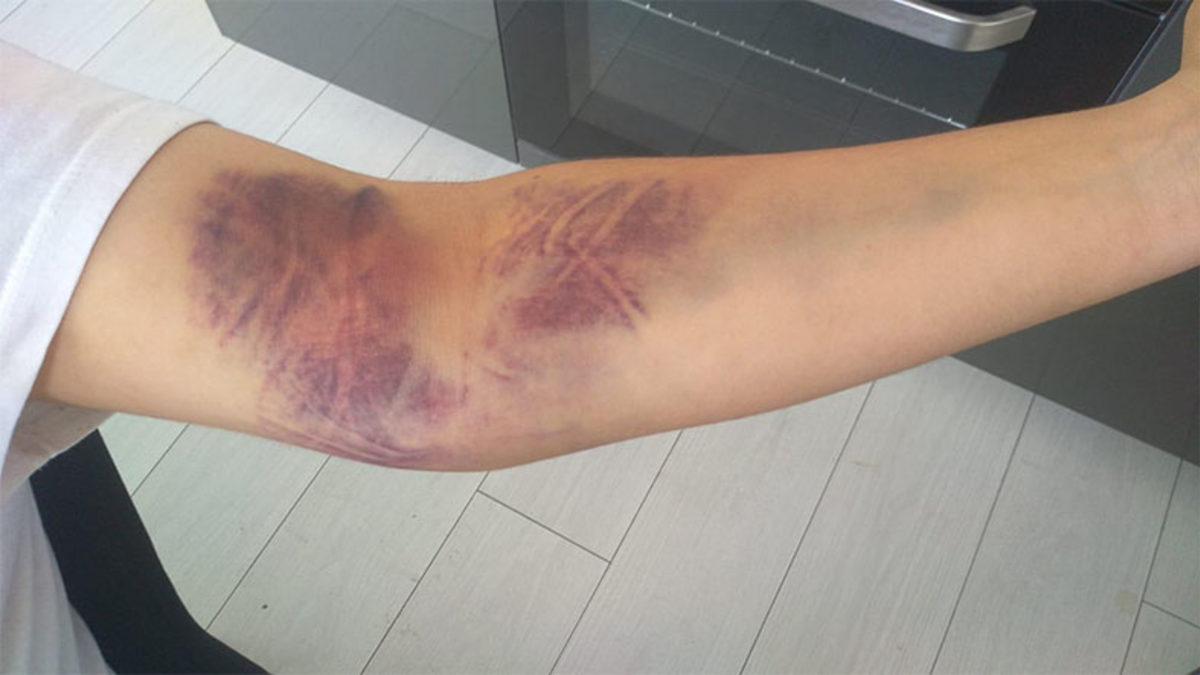 Bilimin Penceresinden Cevaplıyoruz: Kan Verdikten Sonra Kolumuz Neden Morarıyor?