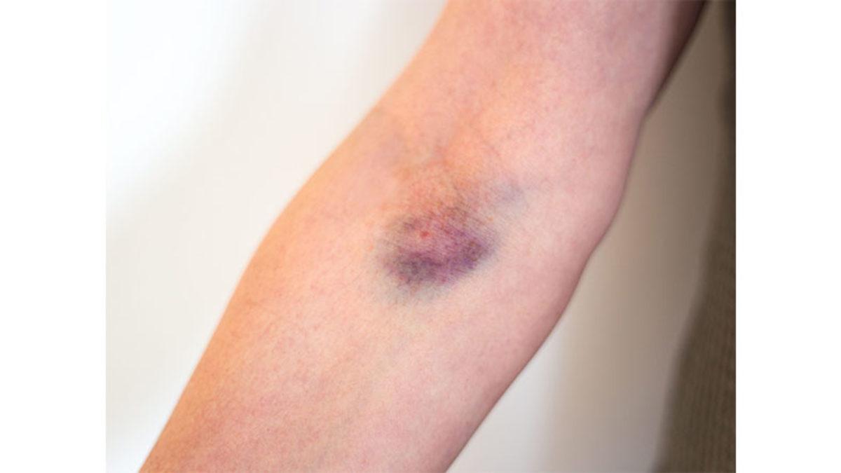 Bilimin Penceresinden Cevaplıyoruz: Kan Verdikten Sonra Kolumuz Neden Morarıyor?