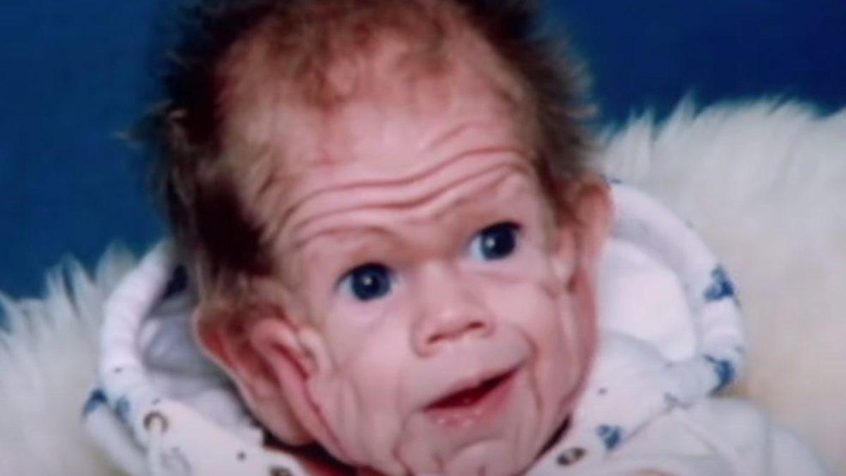 Nadir Görülen Bir Rahatsızlık Sebebiyle Yaşlı Bir İnsan Cildiyle Dünyaya Gelen Bebeğin Ağızları Açık Bırakacak Hikâyesi