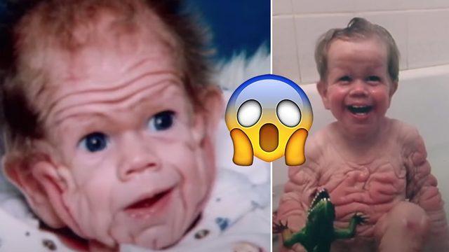 Nadir Görülen Bir Rahatsızlık Sebebiyle Yaşlı Bir İnsan Cildiyle Dünyaya Gelen Bebeğin Ağızları Açık Bırakacak Hikâyesi