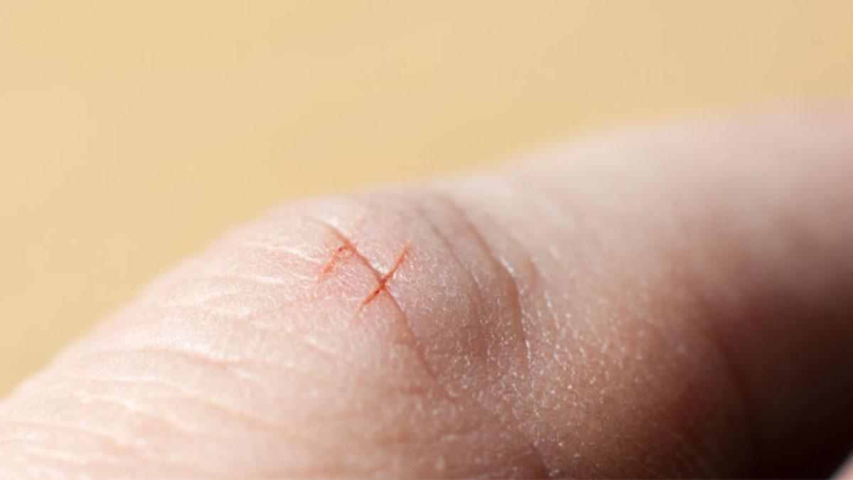 Vücudumuzdaki Düz Yaralar Dalgalı Yaralara Göre Neden Çok Daha Geç İyileşiyor?