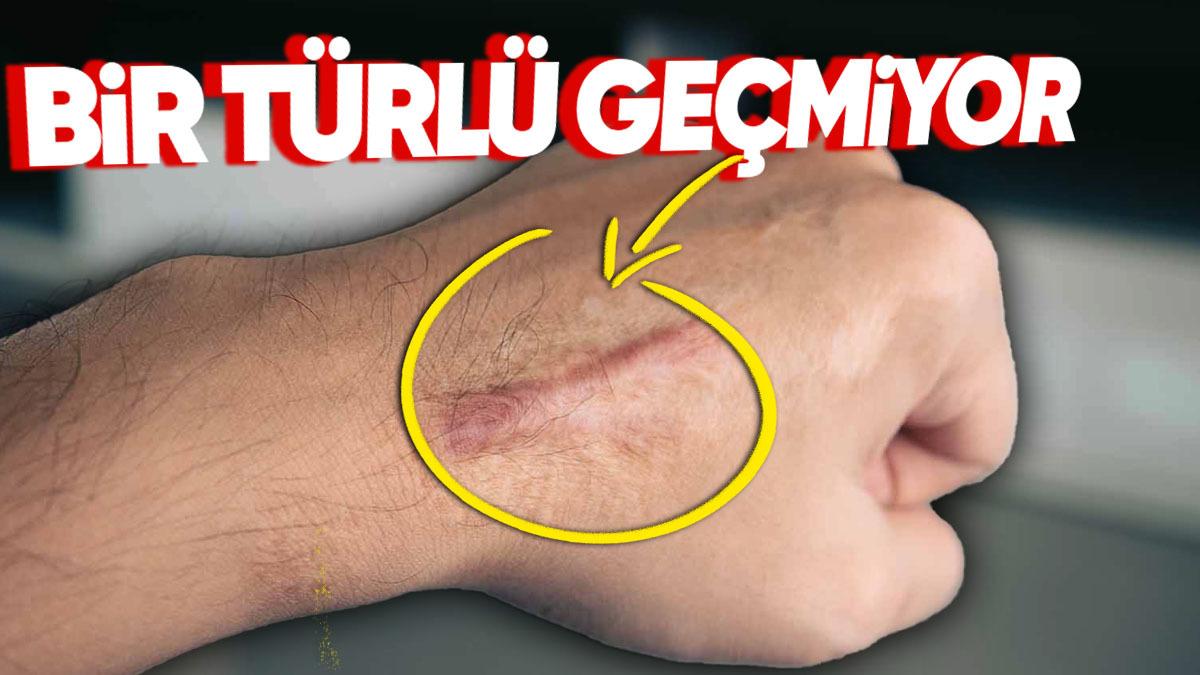 Vücudumuzdaki Düz Yaralar Dalgalı Yaralara Göre Neden Çok Daha Geç İyileşiyor?