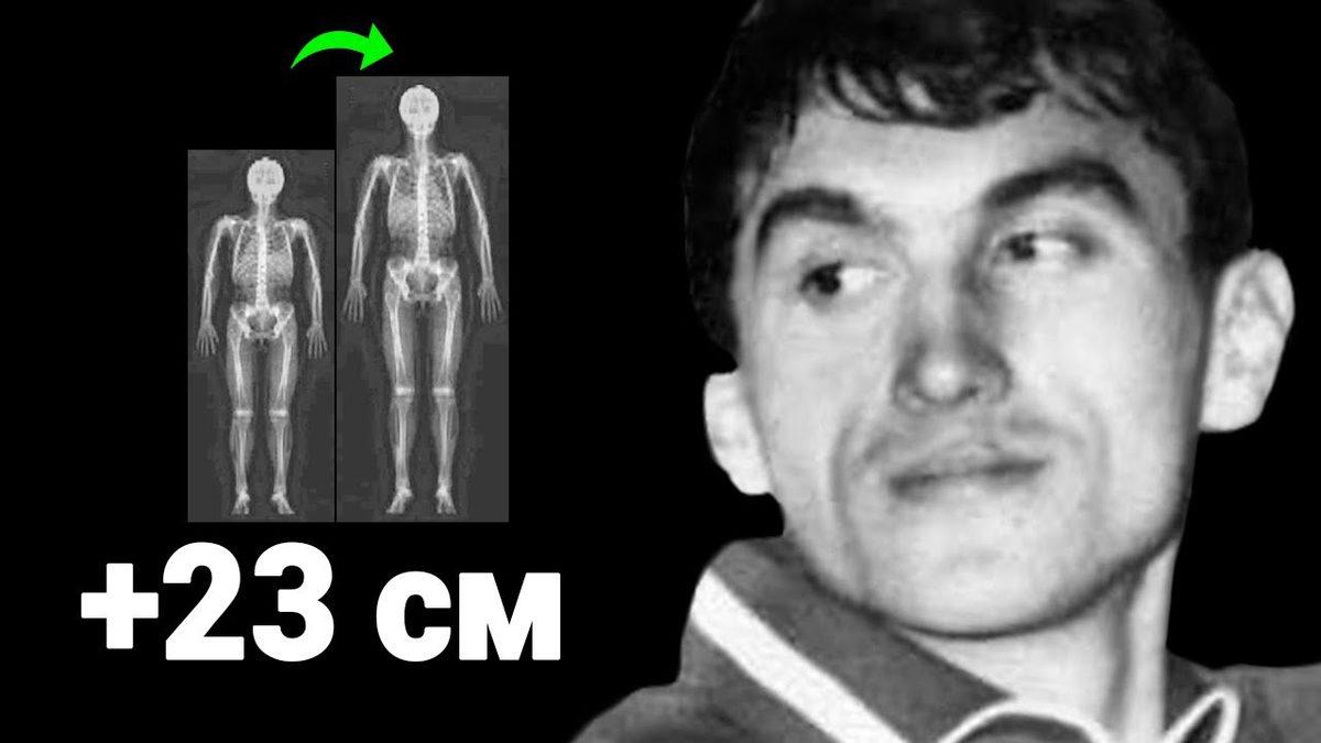 Hâlâ Umut Var: Boyunu 3 Senede 23 cm Uzatmayı Başaran Adam Bunu Nasıl Yaptı?