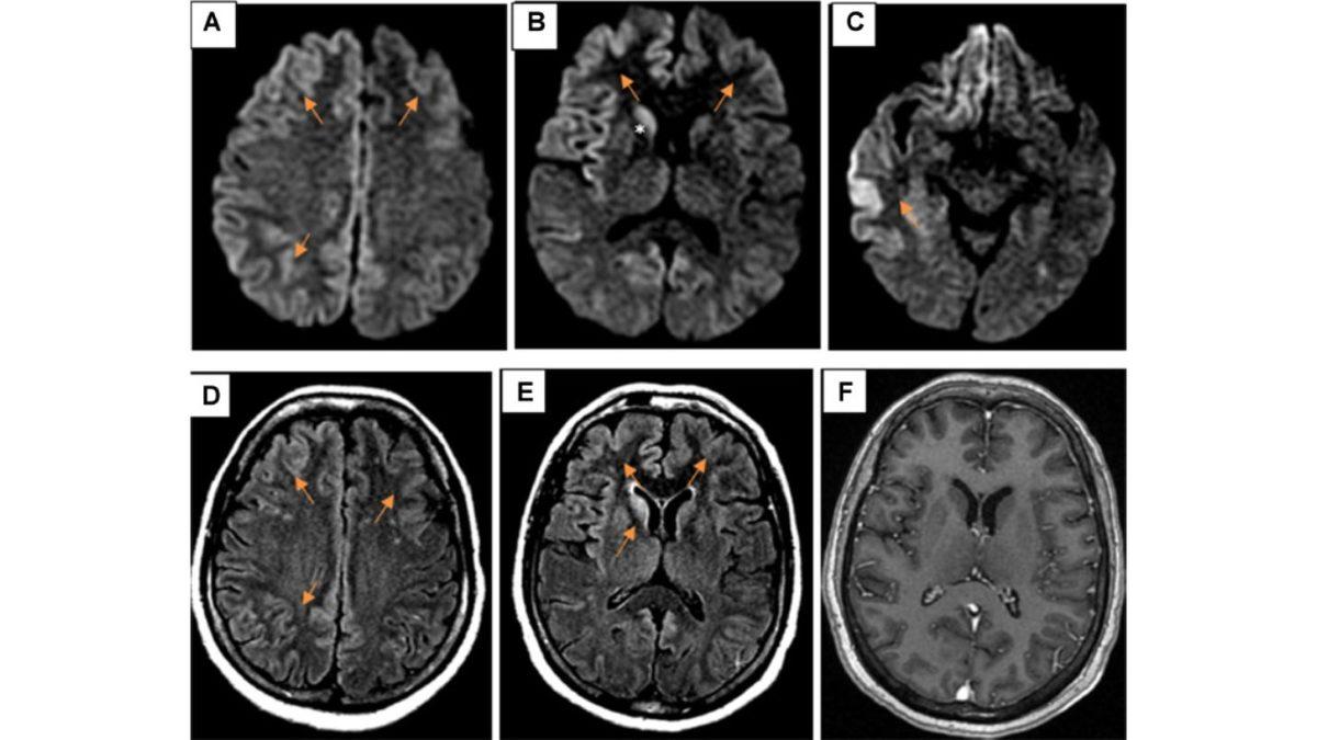 İnsan Beyninde Delikler Oluşmasına Neden Olan Nadir ve Bir O Kadar Tuhaf Hastalık: Creutzfeldt-Jakob