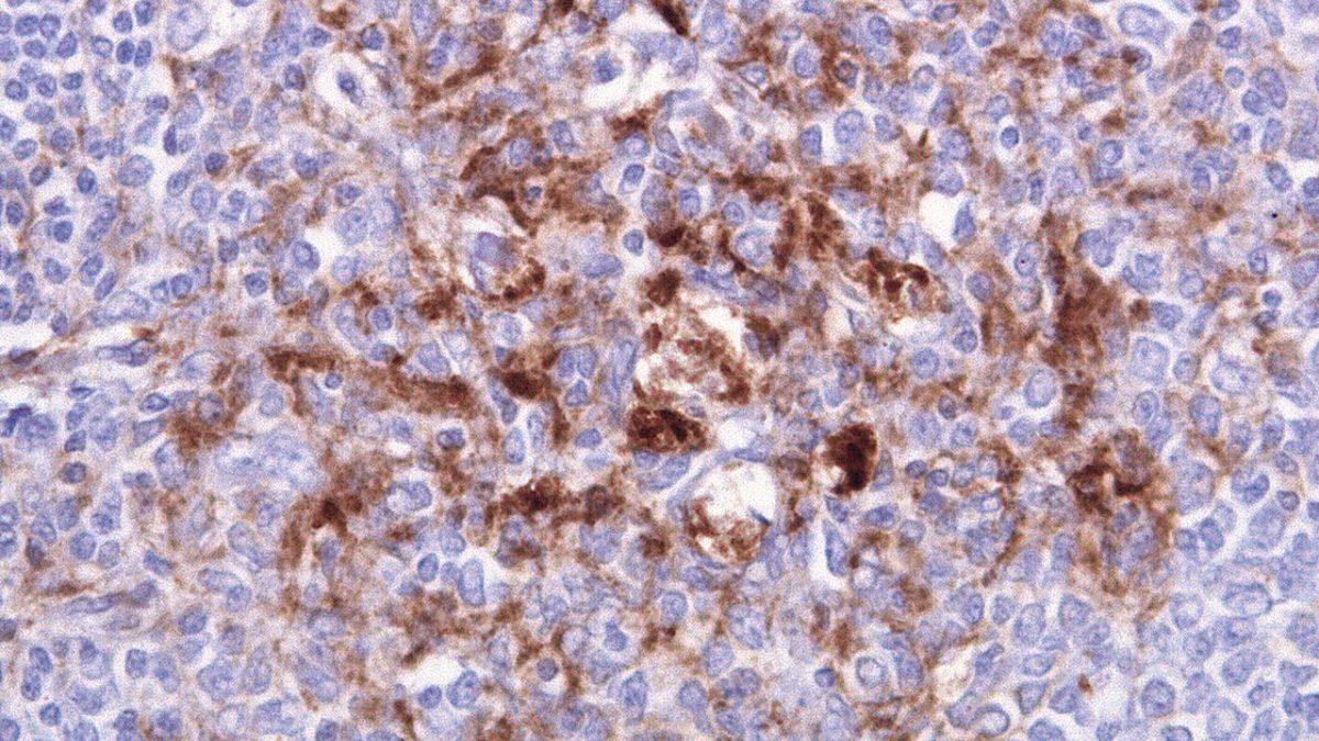 İnsan Beyninde Delikler Oluşmasına Neden Olan Nadir ve Bir O Kadar Tuhaf Hastalık: Creutzfeldt-Jakob