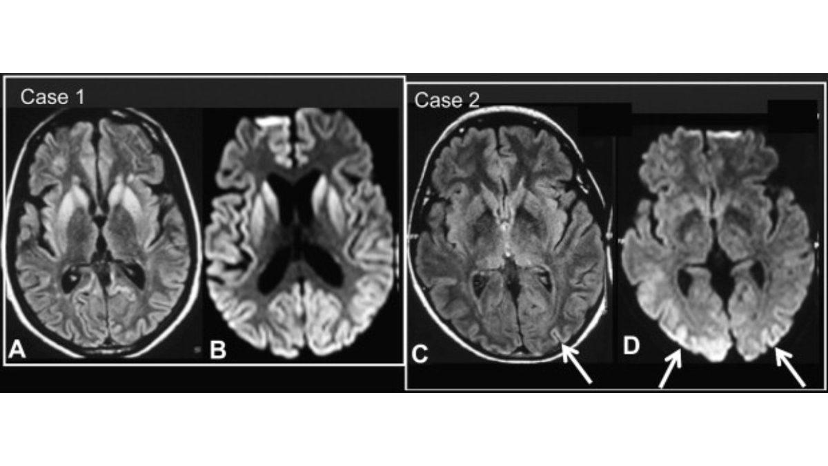 İnsan Beyninde Delikler Oluşmasına Neden Olan Nadir ve Bir O Kadar Tuhaf Hastalık: Creutzfeldt-Jakob