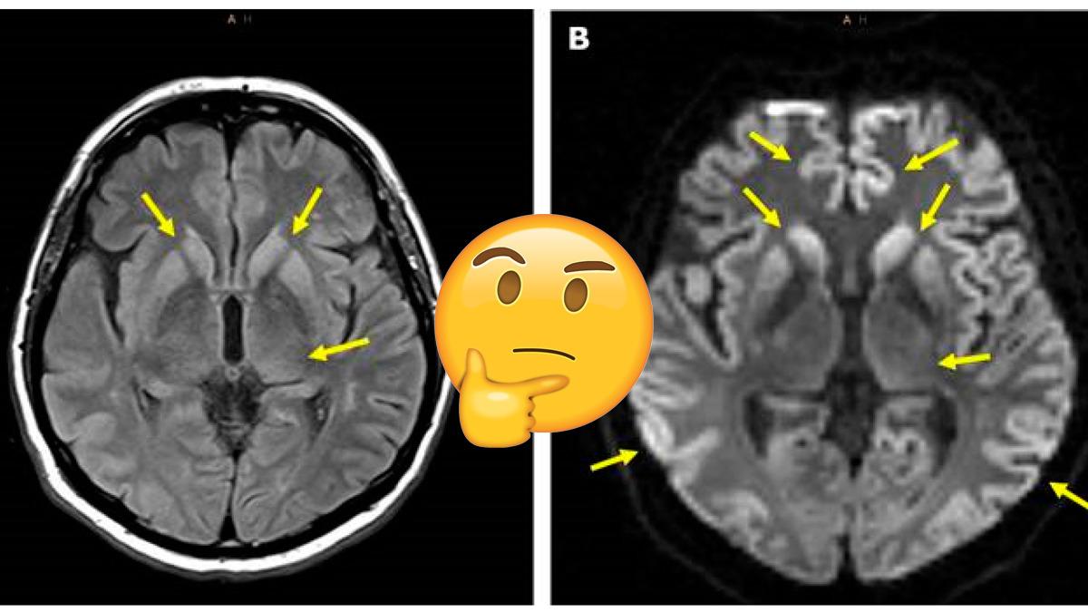 İnsan Beyninde Delikler Oluşmasına Neden Olan Nadir ve Bir O Kadar Tuhaf Hastalık: Creutzfeldt-Jakob