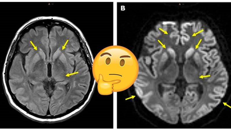 İnsan Beyninde Delikler Oluşmasına Neden Olan Nadir ve Bir O Kadar Tuhaf Hastalık: Creutzfeldt-Jakob