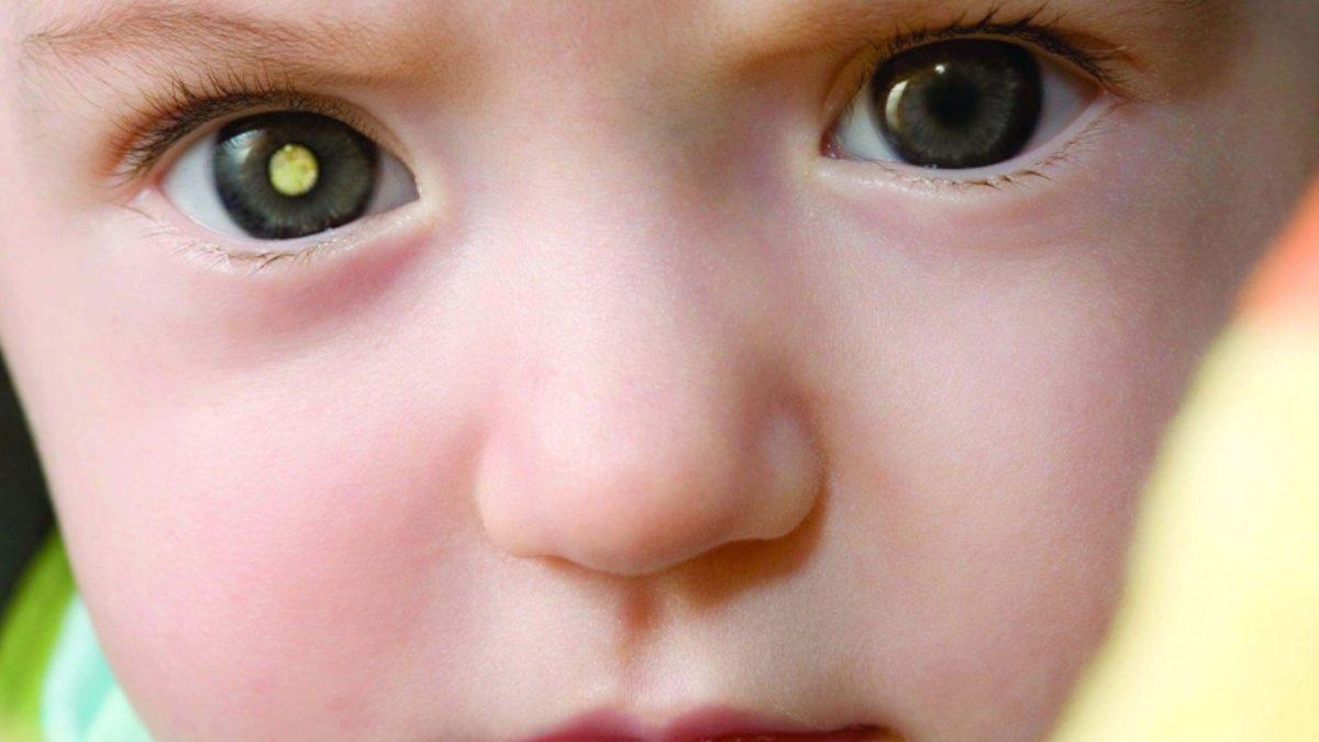 Yakalananları Kör ve Sağır Eden ’Norrie Hastalığı’na Dair Çarpıcı Detaylar: Büyük Oranda Erkekleri Etkiliyor!