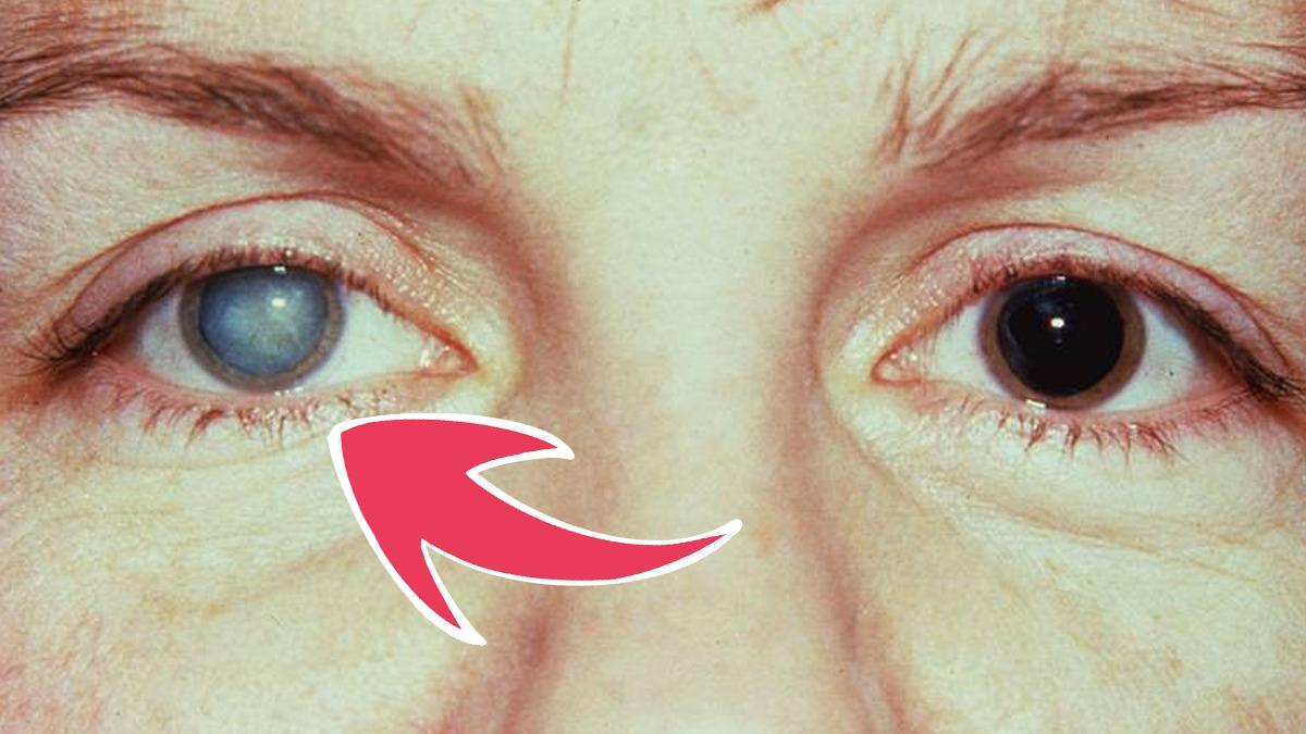 Yakalananları Kör ve Sağır Eden ’Norrie Hastalığı’na Dair Çarpıcı Detaylar: Büyük Oranda Erkekleri Etkiliyor!