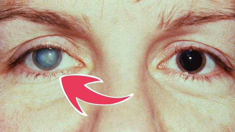 Yakalananları Kör ve Sağır Eden ’Norrie Hastalığı’na Dair Çarpıcı Detaylar: Büyük Oranda Erkekleri Etkiliyor!