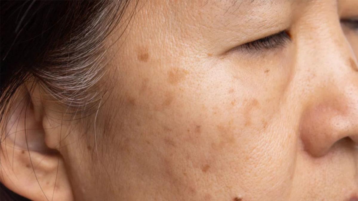 Güneş Kremlerini Boşa mı Kullanıyoruz? İşte Yaşlandıkça Cildimizde Oluşan Koyu Lekelerin Sebebi