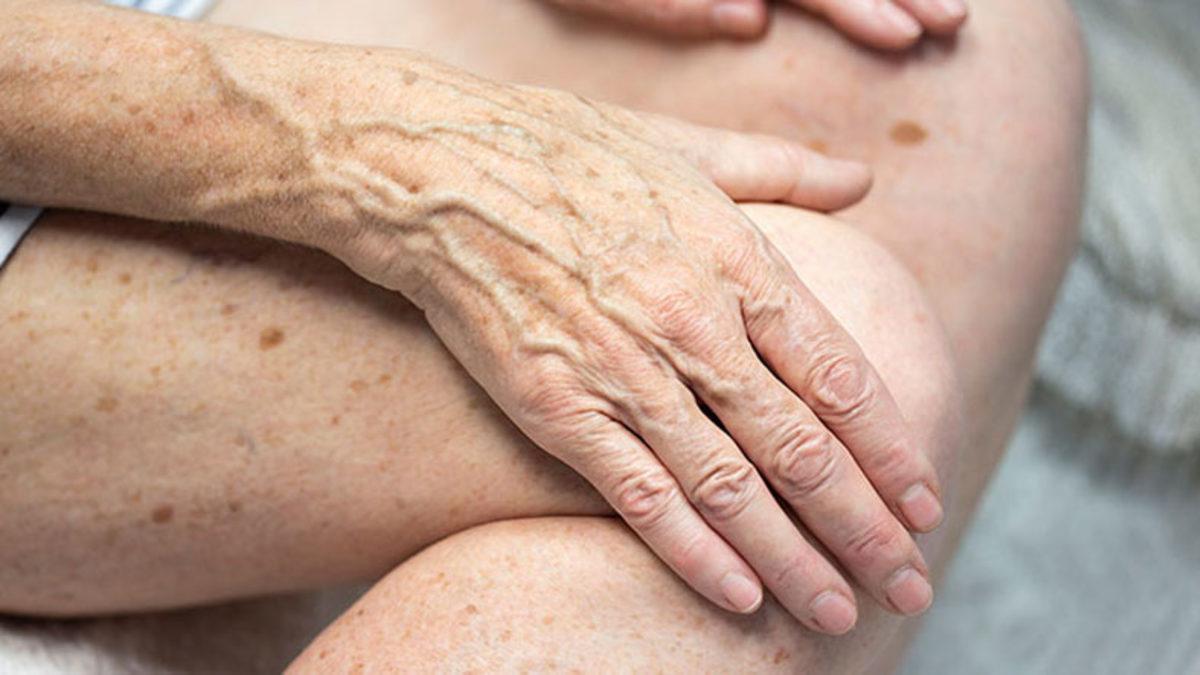 Güneş Kremlerini Boşa mı Kullanıyoruz? İşte Yaşlandıkça Cildimizde Oluşan Koyu Lekelerin Sebebi