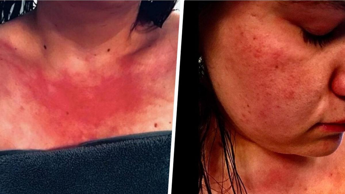 Duş, Yağmur, Ter... Hepsi Yasak! Su Alerjisiyle Yaşamak Nasıl Bir Şey?