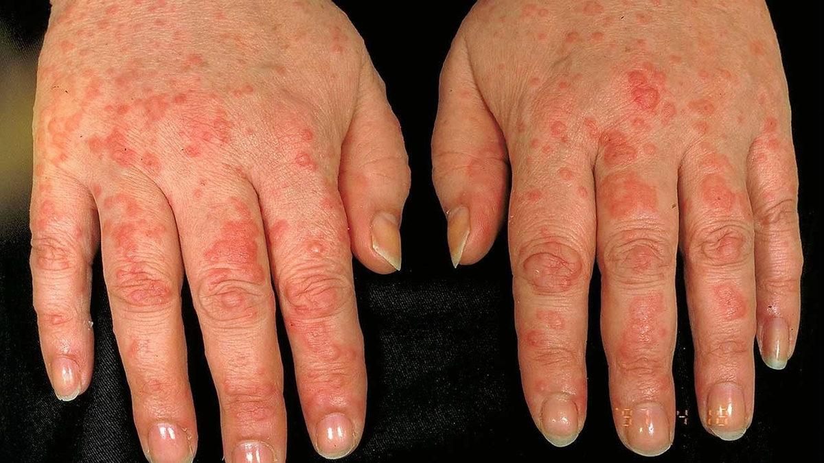 Duş, Yağmur, Ter... Hepsi Yasak! Su Alerjisiyle Yaşamak Nasıl Bir Şey?