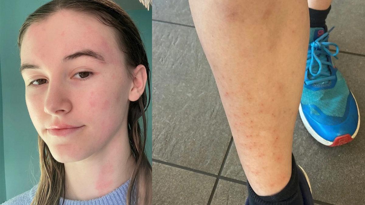 Duş, Yağmur, Ter... Hepsi Yasak! Su Alerjisiyle Yaşamak Nasıl Bir Şey?