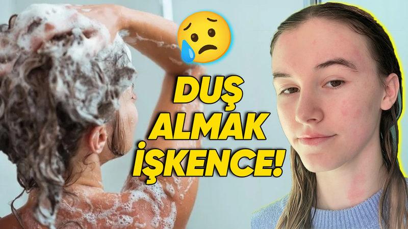 Duş, Yağmur, Ter... Hepsi Yasak! Su Alerjisiyle Yaşamak Nasıl Bir Şey?