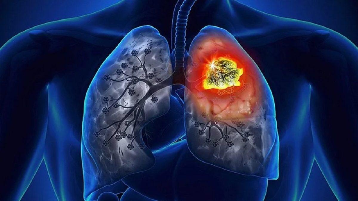 Özellikle Sigara İçmeyen Kişilerde Akciğer Kanseri Riski Neden Artışa Geçiyor? Üstelik Tüm Dünyada!