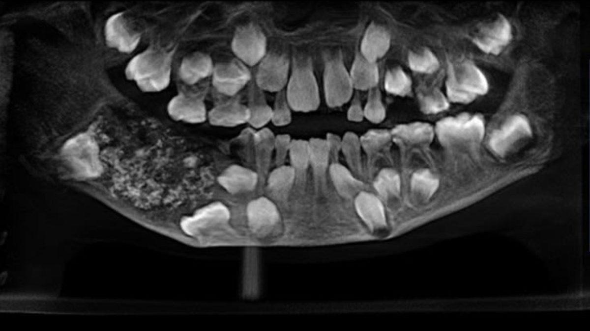 Geçirdiğiniz Hastalıkların ve Yaşadığınız Stresli Olayların Her Birinin, Dişlerinizde Kanıtlar Bıraktığını Gösteren Benzersiz Çalışma