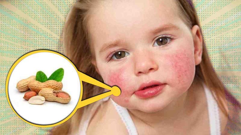 Fıstık ve Fındık Neden Diğer Besinlere Göre Çok Daha Fazla Alerji Riski Taşıyor? Bazılarına Sadece Değmesi Bile Yetiyor!