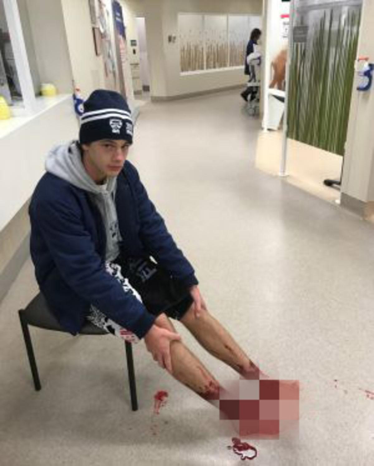 Denize Soktuğu Ayakları Et Yiyen Böcekler Tarafından Perişan Olan Genç Çocuk