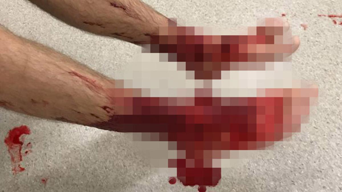 Denize Soktuğu Ayakları Et Yiyen Böcekler Tarafından Perişan Olan Genç Çocuk