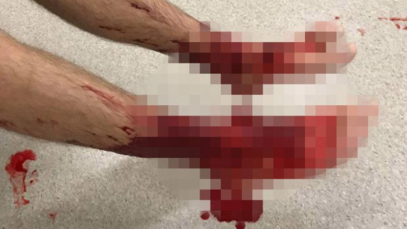 Denize Soktuğu Ayakları Et Yiyen Böcekler Tarafından Perişan Olan Genç Çocuk