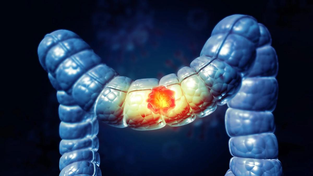 colon-cancer