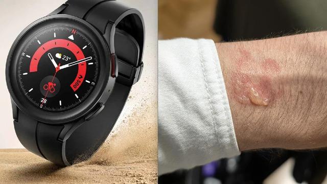 Samsung Galaxy Watch’ta Kullanıcıların Sağlığını Riske Atan Sorun: Bilekleri Yakıyor!