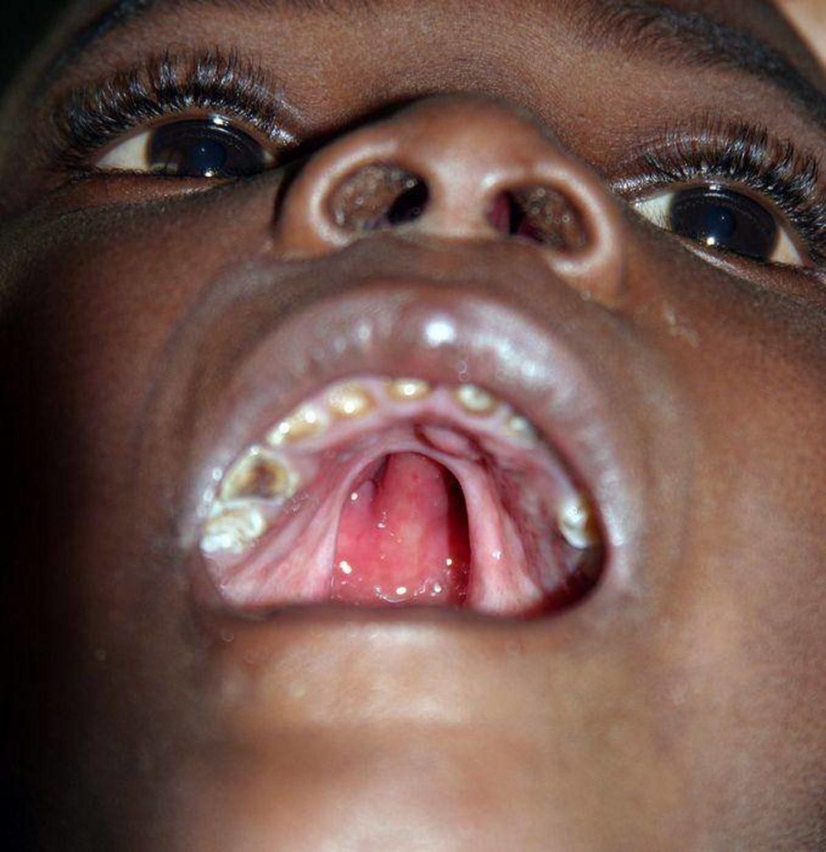 Akraba Evlilikleri Yüzünden Ortaya Çıkmış 10 Genetik Mutasyon!