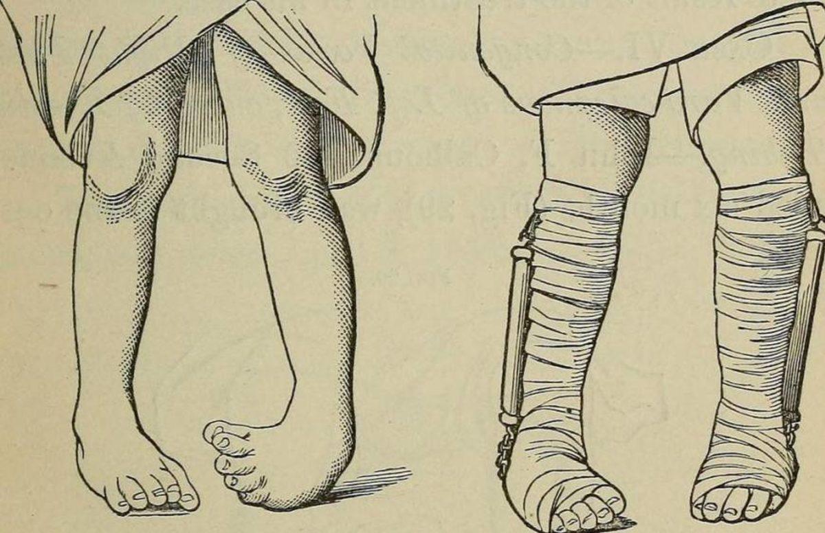 Akraba Evlilikleri Yüzünden Ortaya Çıkmış 10 Genetik Mutasyon!