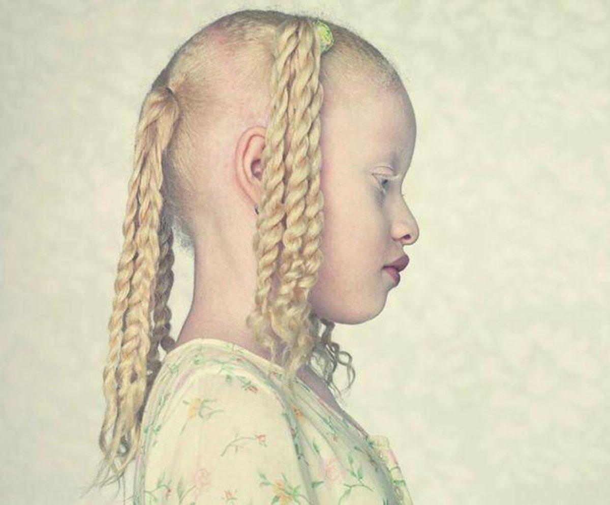 Akraba Evlilikleri Yüzünden Ortaya Çıkmış 10 Genetik Mutasyon!